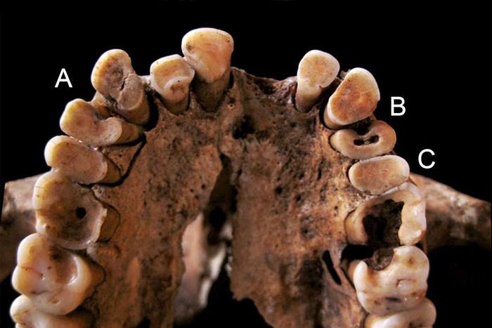 An image of an ancient hominin maxilla revealing signs of tooth decay.