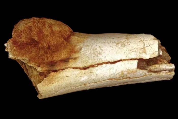 An image of the world’s oldest recorded hominin cancer found on a fossilized toe bone.