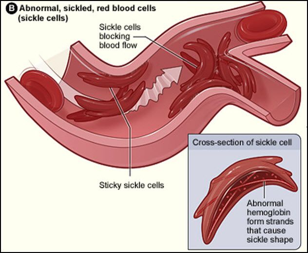 1. sickle-cell