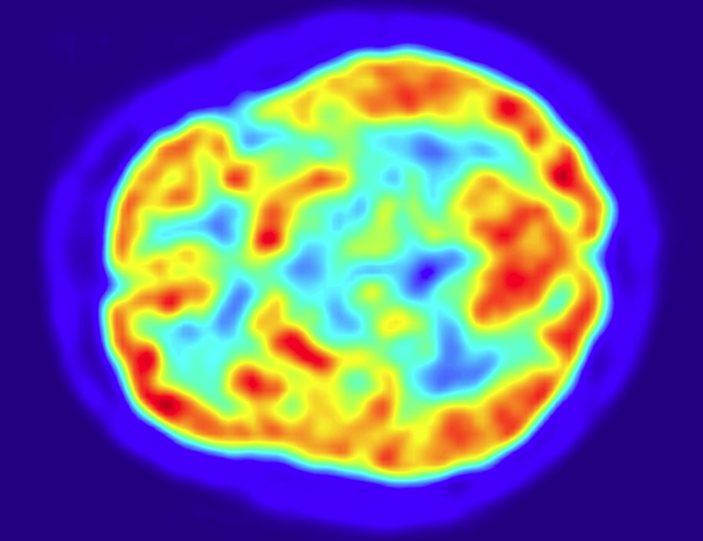 PET Scan of the Brain