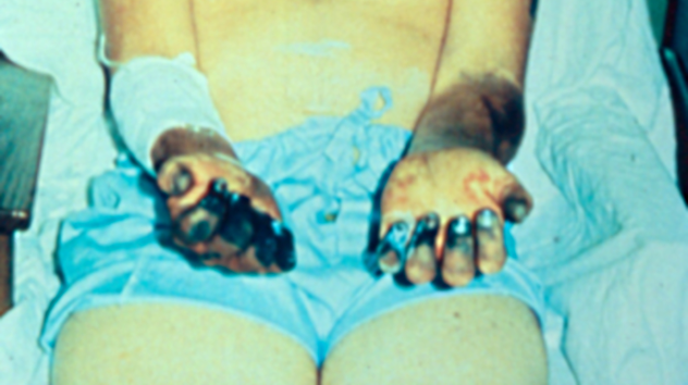 Black Plague Necrosis