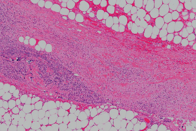 Flesh-Eating Bacteria