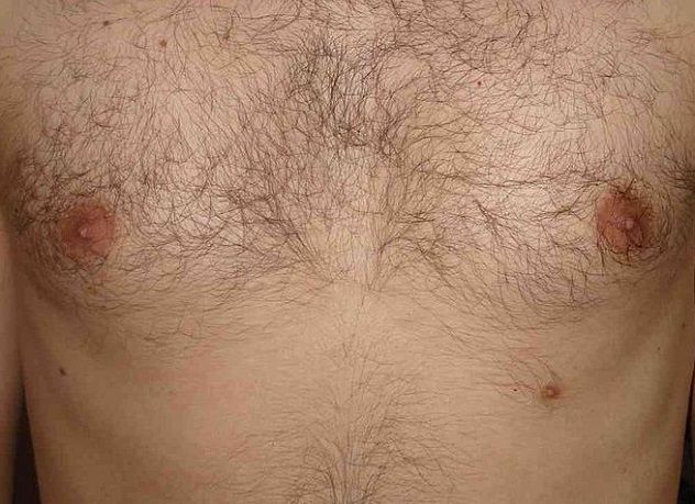 800px-Supernumerary_third_nipple