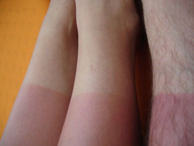 Sunburn