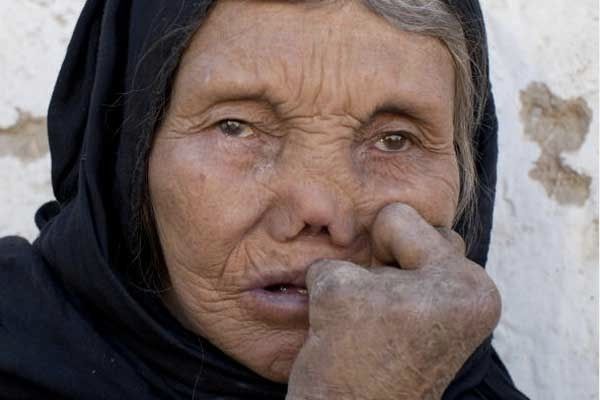 300712-Leprosy