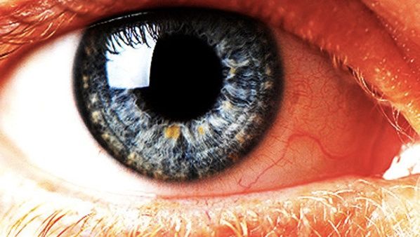 Eye 620X350
