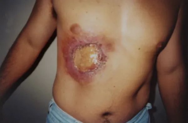 Radiation Burns