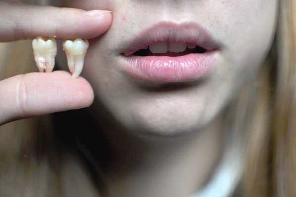 Wisdom Teeth Extracted By Pompay-D2Yo8Th