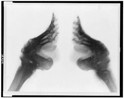 Foot Xray.Jpg
