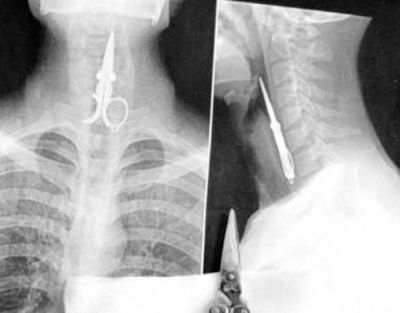 Xray-Cen-498589550.Jpg