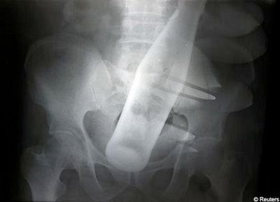 Thieves Push Pepsi Bottle Up Man's Bum 1.Jpg