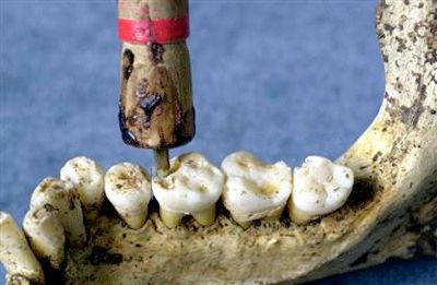 060405 Prehistoric Dentistry Vlgd9A Hmedium.Jpg