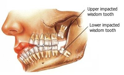 Wisdom Teeth 01 En