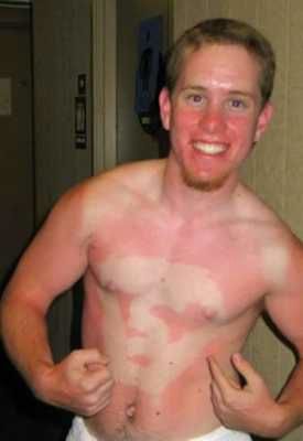 Superman Sunburn