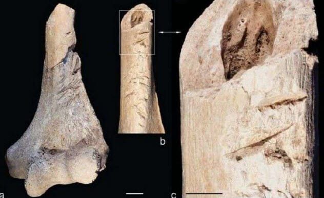 10b-amputated-arm-bones-from-pit