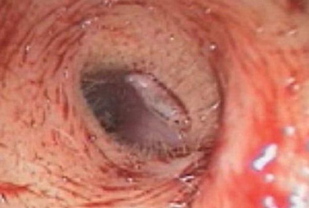 taiwan-ear-maggot