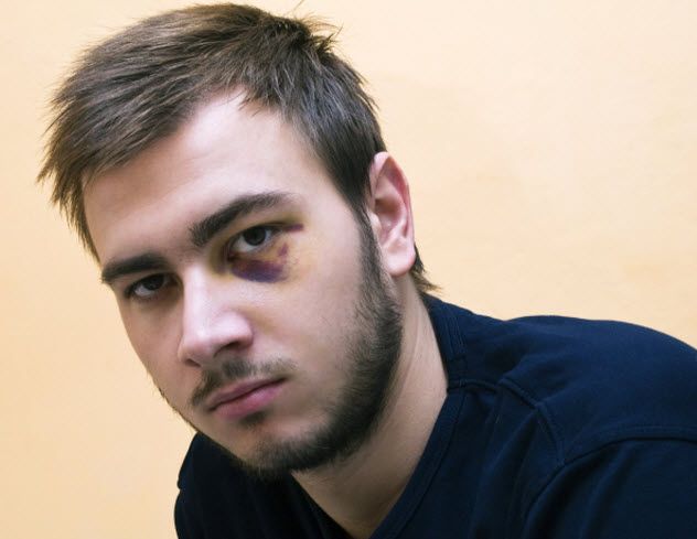4-black-eye-492672210