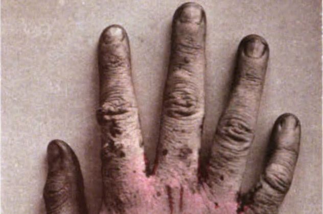 6- scabies