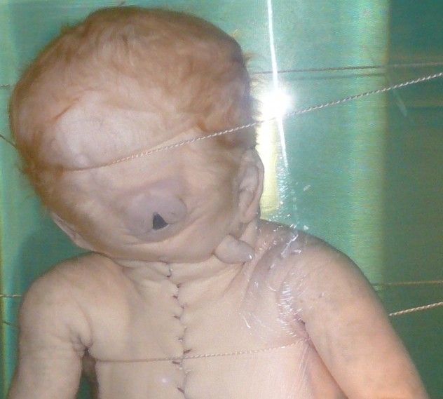 cyclopia