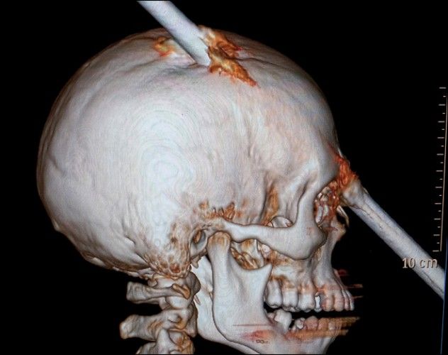skull-penetration