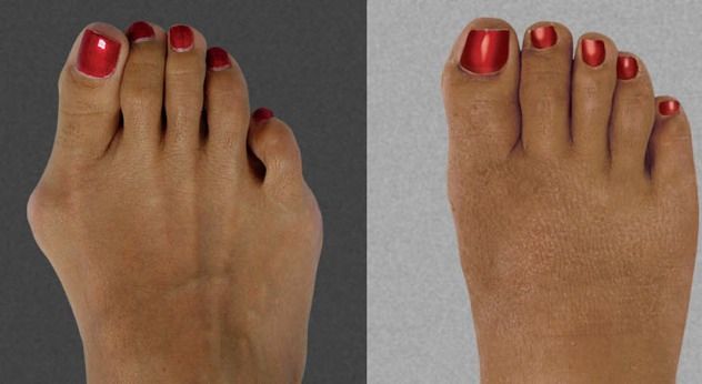 Bunionsurgery1
