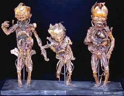 Imfoetus