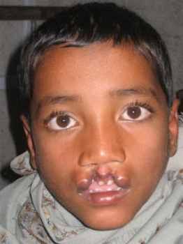 Operation Cleft0019
