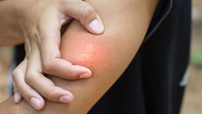 Relieve bee stings