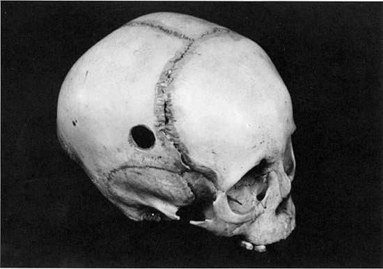 Trepanning-Skull-Granger