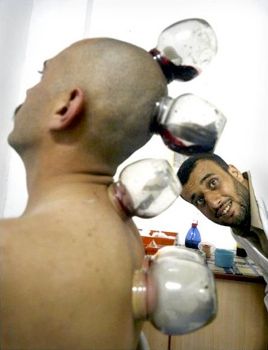 Palbloodletting