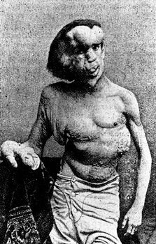 383Px-Josephmerrick1889