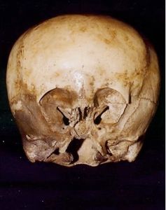 474Px-Starchild Skull 1