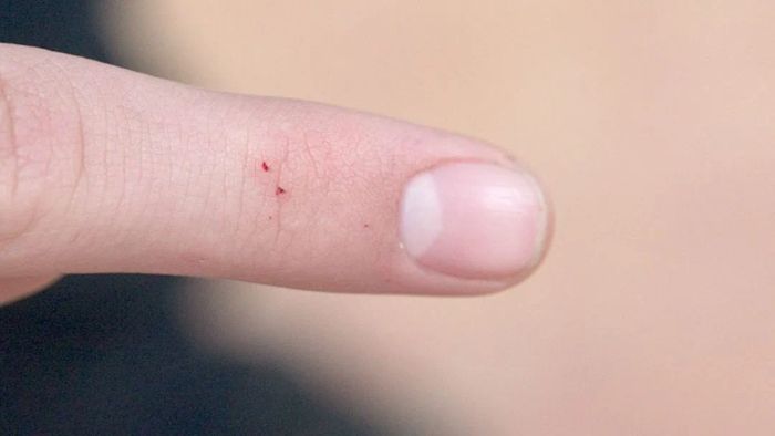 A person's finger displaying two fang marks from a spider bite.