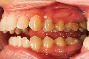 When you have gingivitis, the bacteria in your saliva can spread to other individuals.