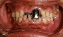 infected teeth and oral tissues