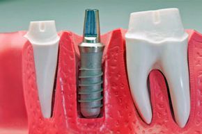 model of dental implants