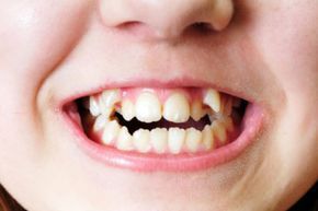 dental imperfections
