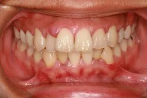inflamed gums