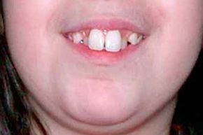 macrodontia in children