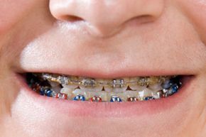 orthodontic braces