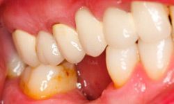 Teeth and gums affected by plaque, tartar, and gingivitis.