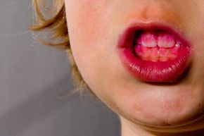 The red dye indicates the presence of plaque