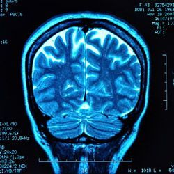 MRI scan of a brain in blue tones