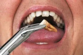 Extracting cracked teeth is a common practice to stop infections from reaching the root canal.