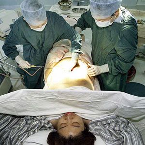 surgical procedure for smart liposuction