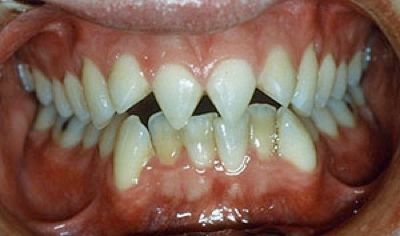 Tooth Filing