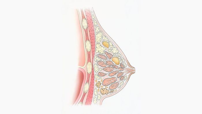 Visual representation of fibrocystic breast disease