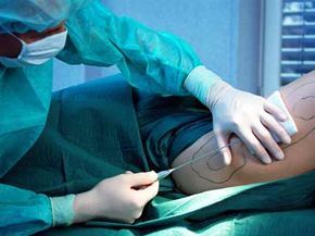 A woman undergoing liposuction