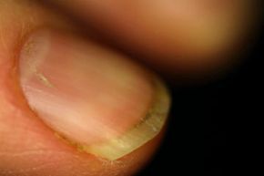 damaged fingernail