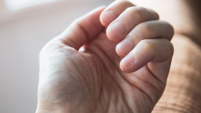 An image depicting a hangnail on the pinky finger of a hand.